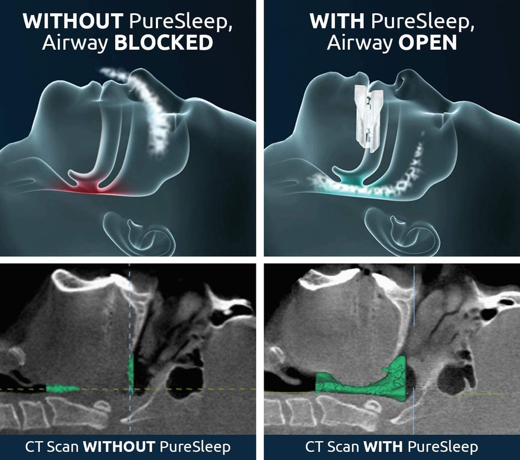 puresleep-the-original-anti-snoring-mout-3.jpg