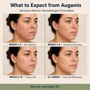 hormonal-acne-treatment-for-women-dim-fr-2.jpg
